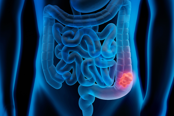 Colon-Cancer-Illustrated-Feature-DTM